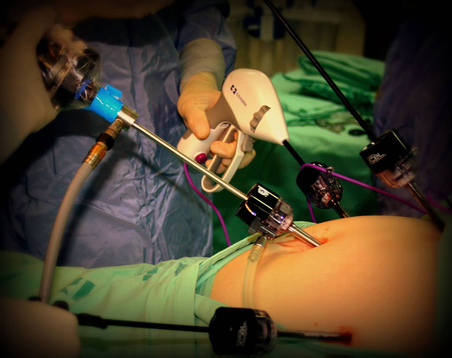 Advanced Laparoscopic Surgery